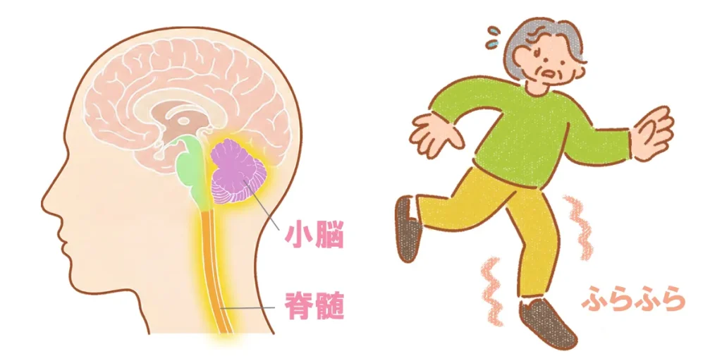 脊髄小脳変性症は小脳や脊髄の神経細胞が変性する病気の総称